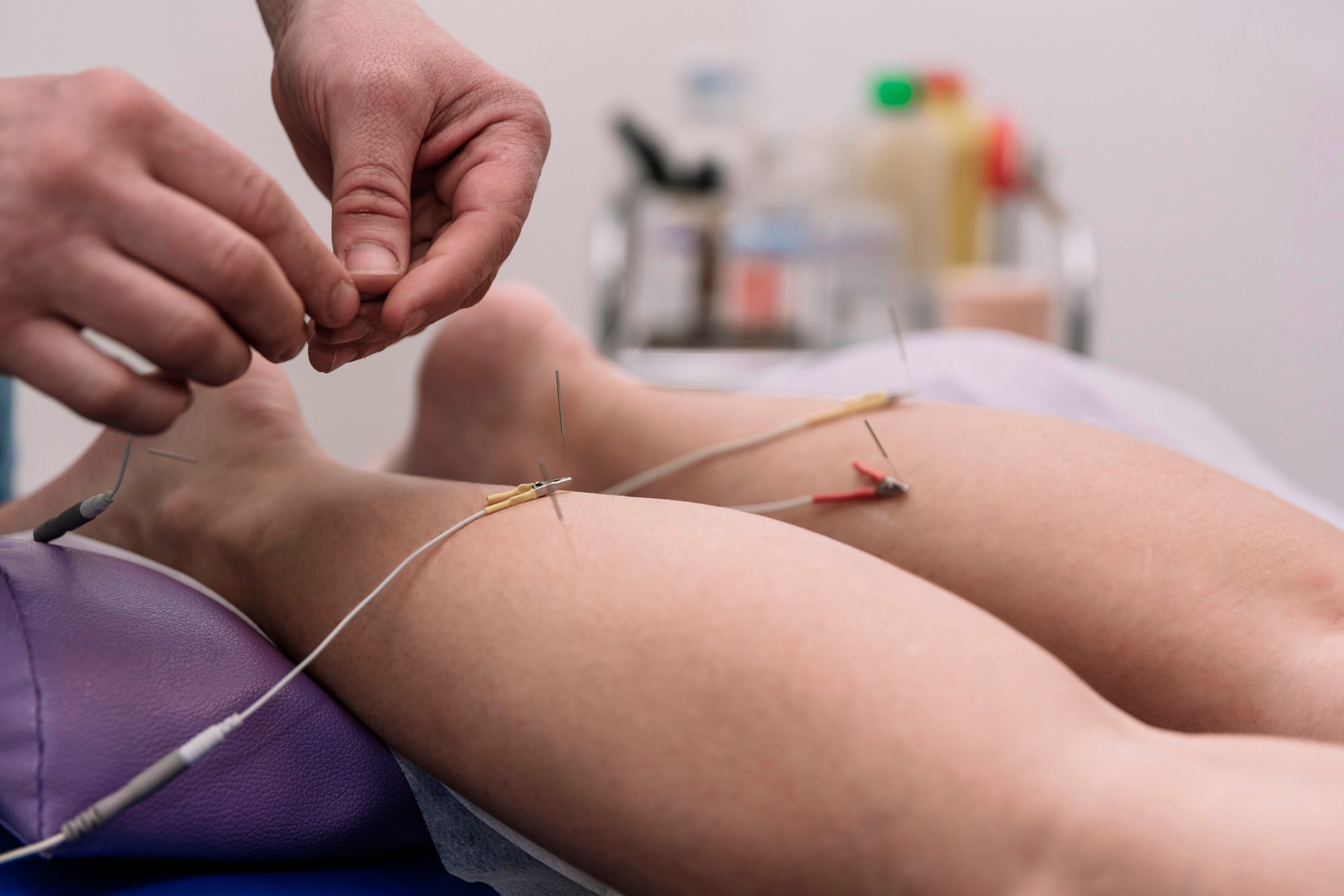 electrical-stimulation-in-physiotherapy-in-the-phy-2025-03-13-01-23-18-utc