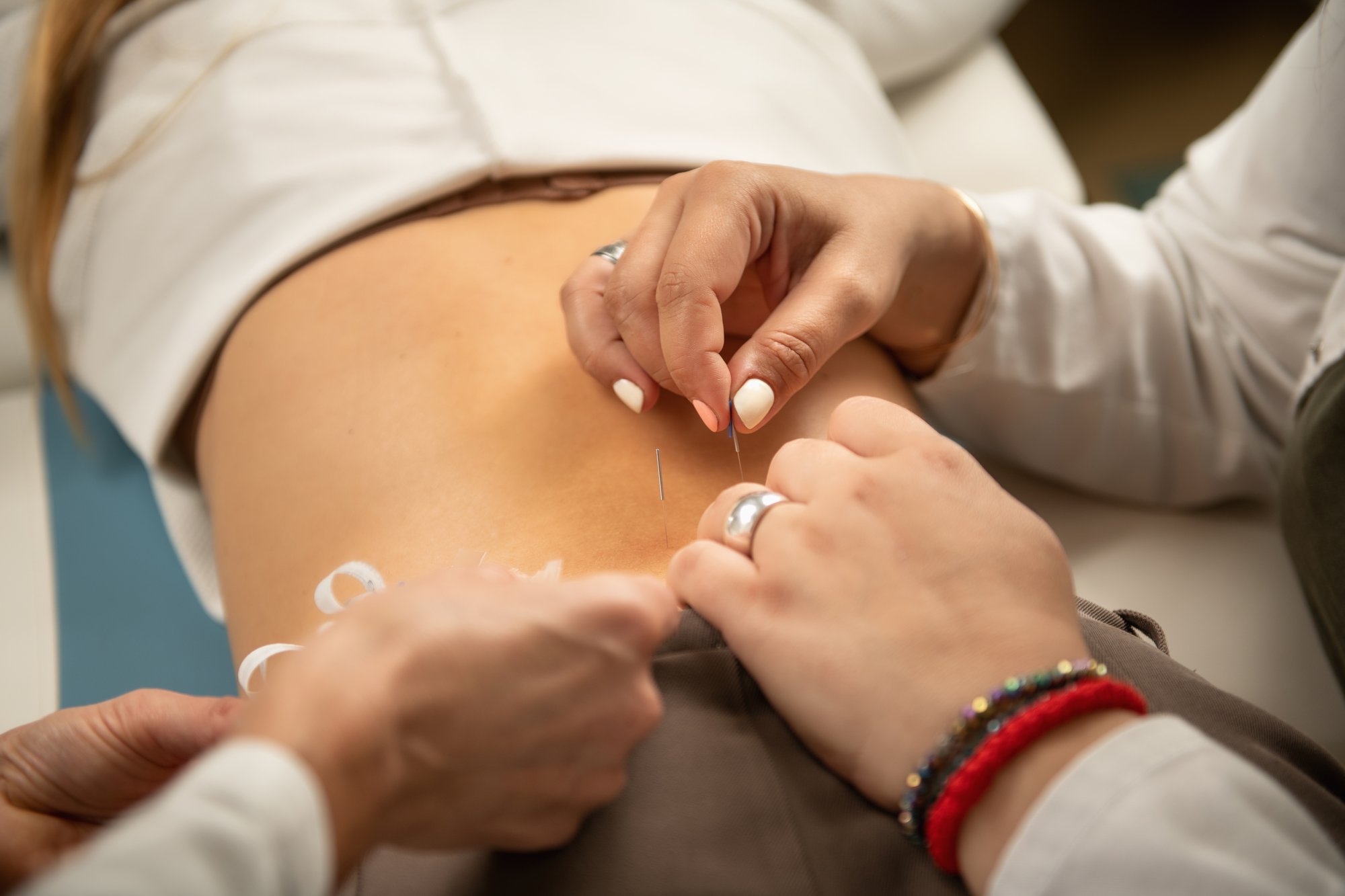 sciatica-back-pain-acupuncture-treatment-2024-10-18-19-31-56-utc